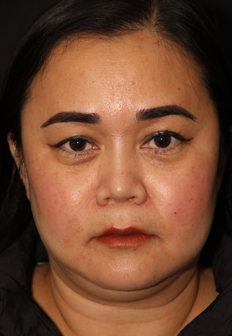 Female patient after alar reduction