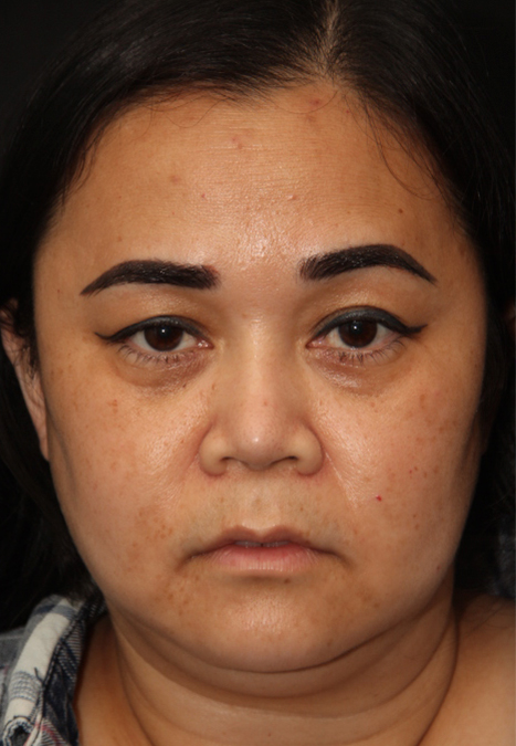 Female patient before alar reduction