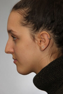 Female patient before primary rhinoplasty