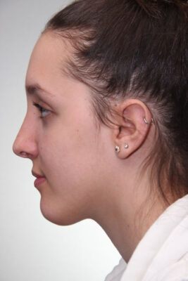 Female patient after primary rhinoplasty