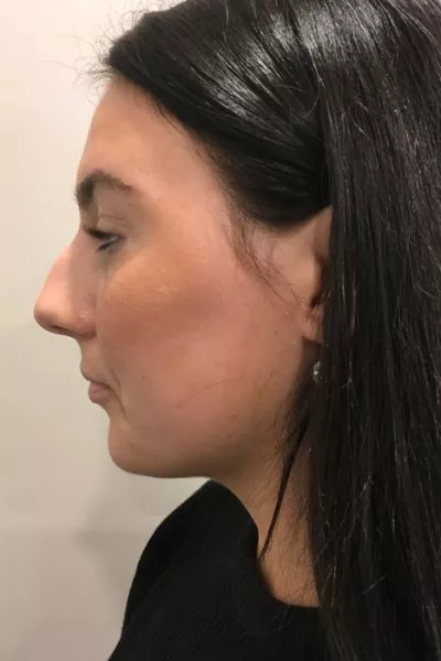 Female patient after injectable rhinoplasty