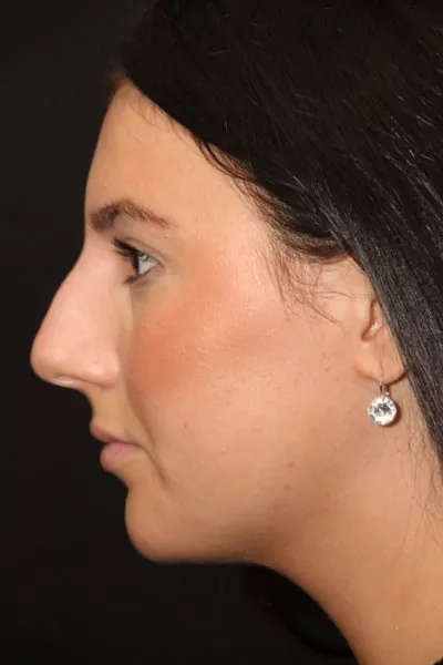 Female patient before injectable rhinoplasty