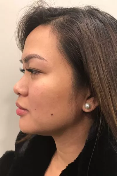 Female patient before injectable rhinoplasty
