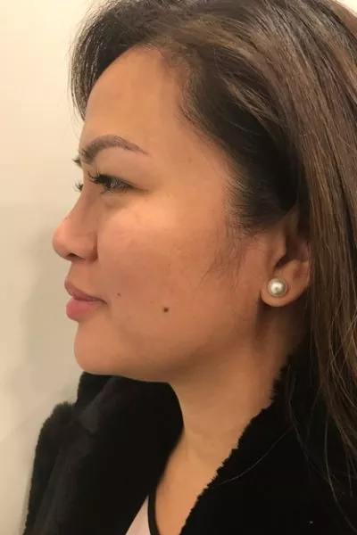 Female patient after injectable rhinoplasty