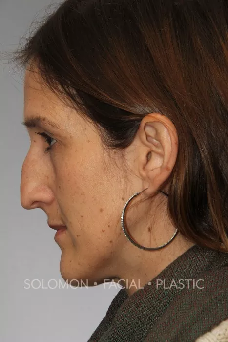 Female patient before primary rhinoplasty