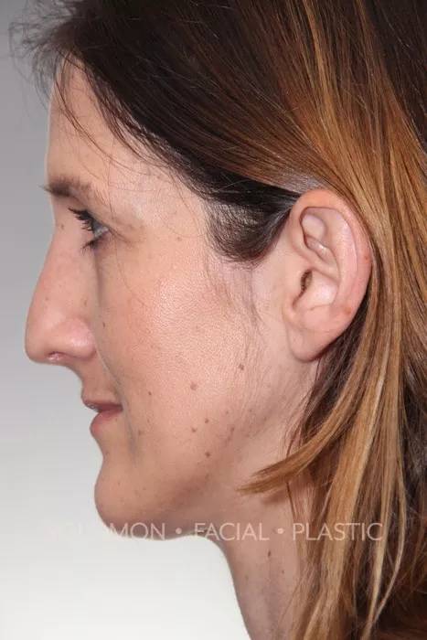 Female patient after primary rhinoplasty