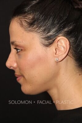 Female patient after primary rhinoplasty