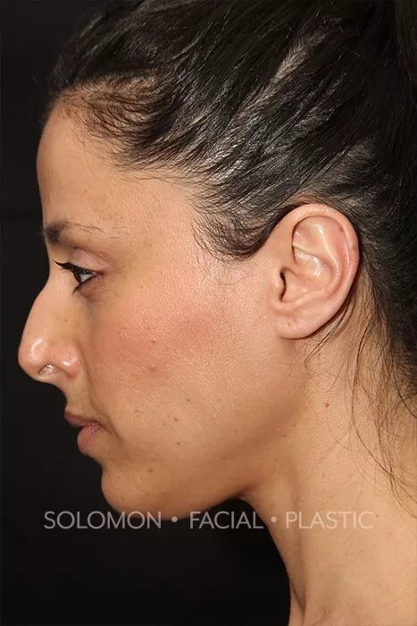 Female patient before primary rhinoplasty