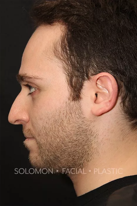 Male patient before primary rhinoplasty
