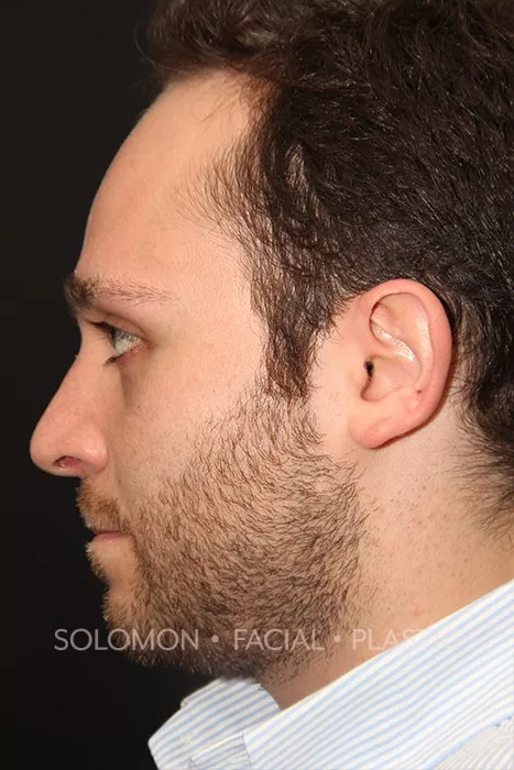 Male patient after primary rhinoplasty
