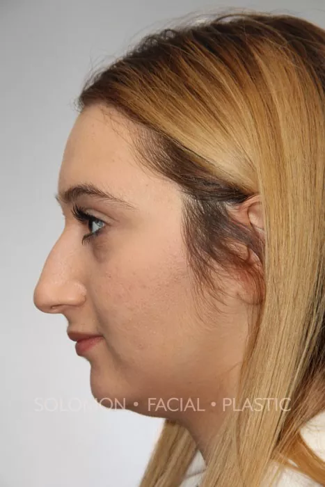 Female patient before primary rhinoplasty