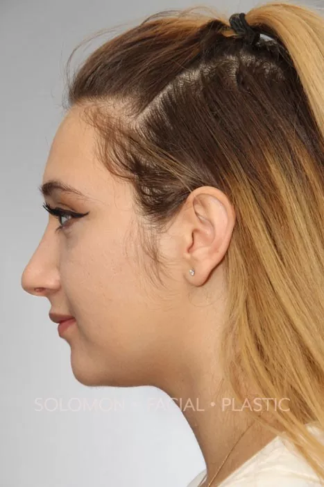 Female patient after primary rhinoplasty