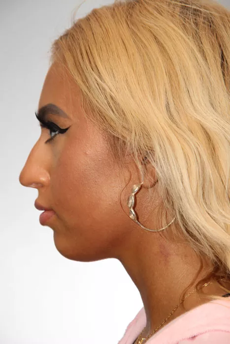 Female patient before primary rhinoplasty