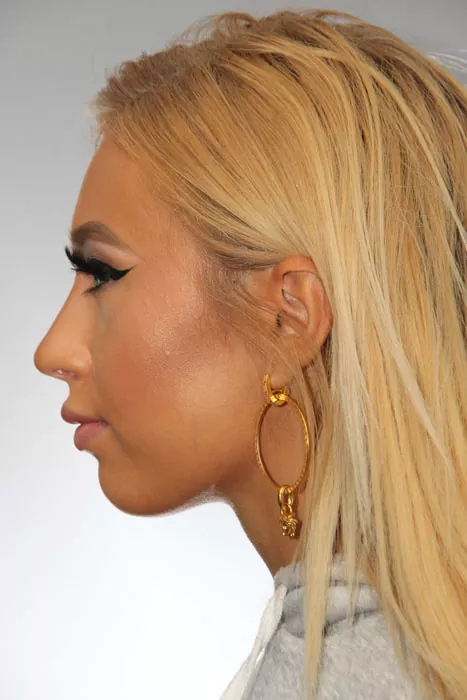 Female patient after primary rhinoplasty