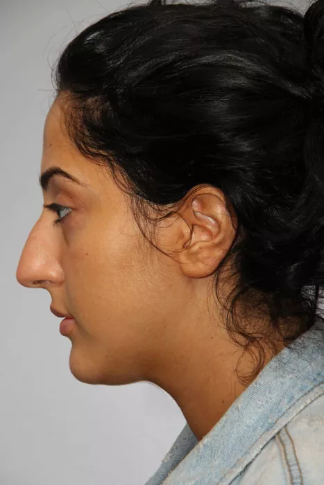 Female patient before primary rhinoplasty
