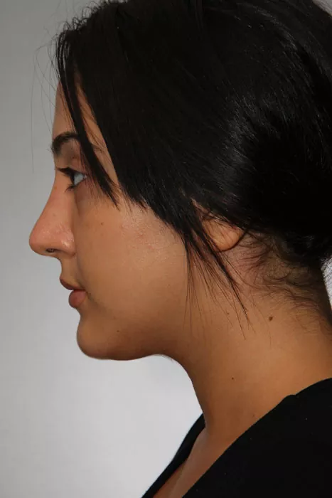 Female patient after primary rhinoplasty