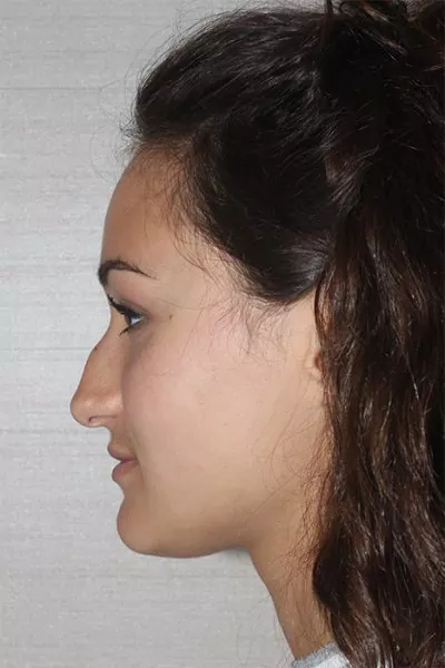 Female patient before primary rhinoplasty