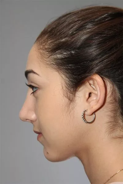 Female patient after primary rhinoplasty