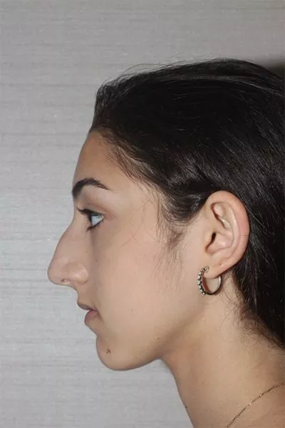 Female patient before primary rhinoplasty