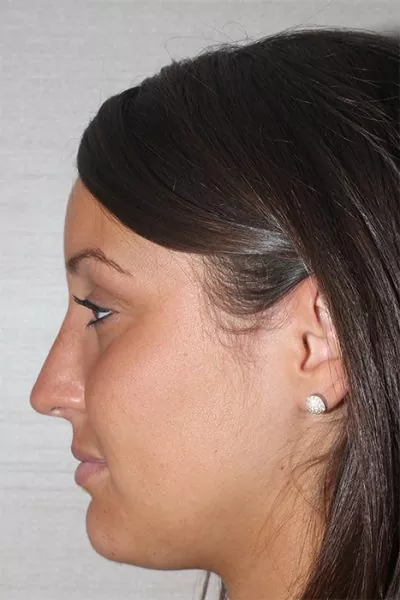 Female patient after primary rhinoplasty