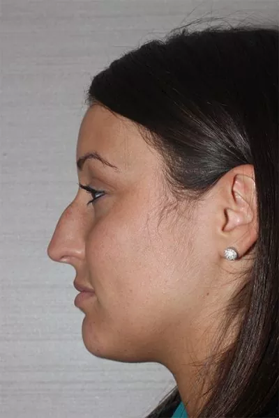 Female patient before primary rhinoplasty