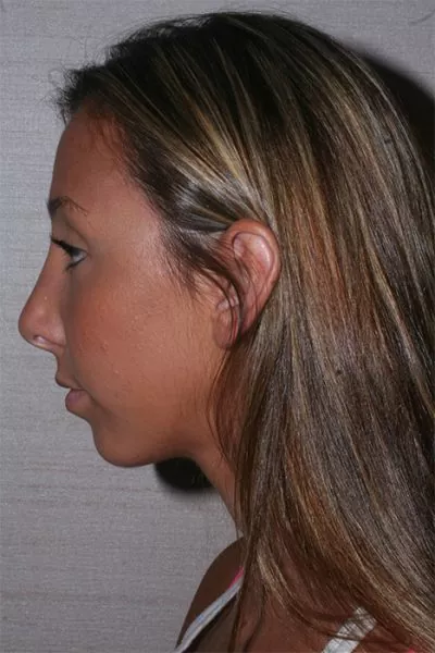 Female patient after primary rhinoplasty