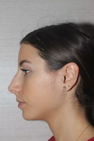 Female patient before primary rhinoplasty