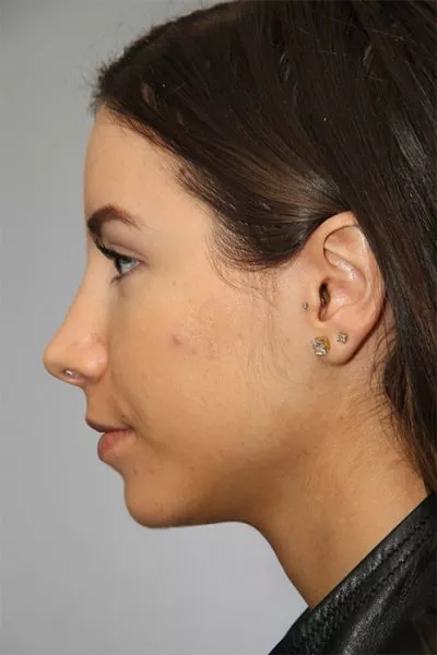 Female patient after primary rhinoplasty