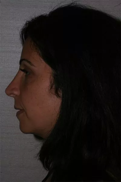 Female patient after primary rhinoplasty
