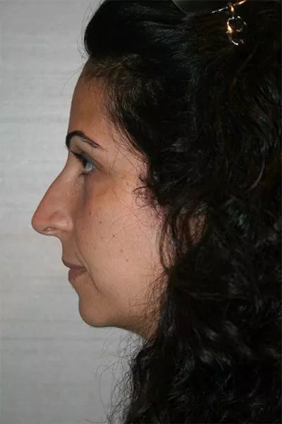 Female patient before primary rhinoplasty