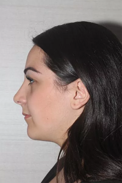 Female patient after primary rhinoplasty