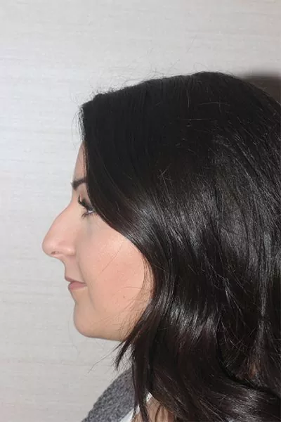 Female patient before primary rhinoplasty
