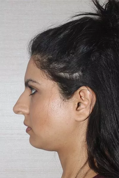 Female patient before primary rhinoplasty