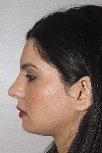 Female patient after primary rhinoplasty