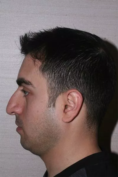 Male patient before primary rhinoplasty