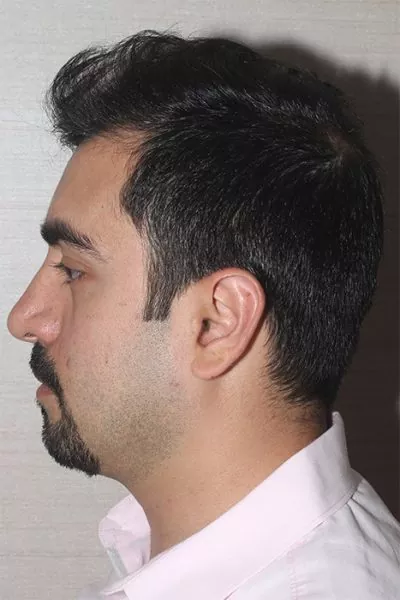 Male patient after primary rhinoplasty