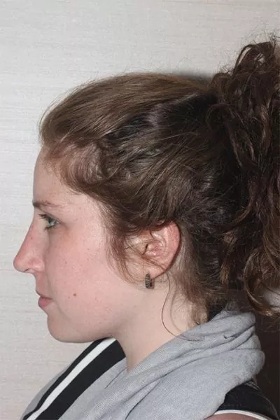 Female patient after primary rhinoplasty