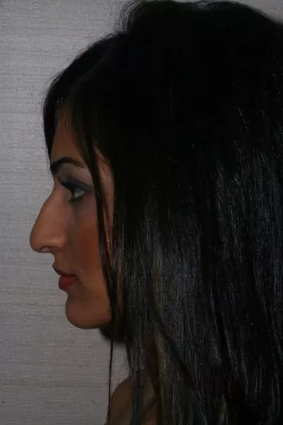 Female patient before primary rhinoplasty