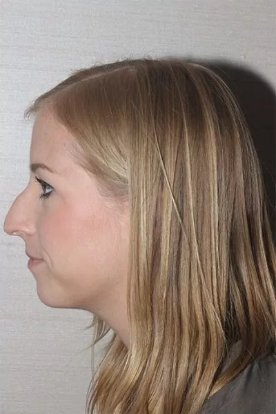 Female patient before primary rhinoplasty