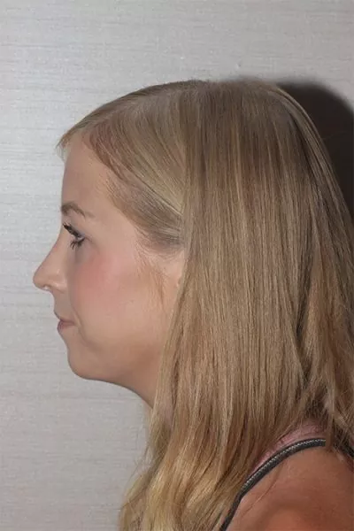 Female patient after primary rhinoplasty