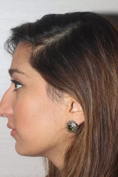 Female patient before primary rhinoplasty