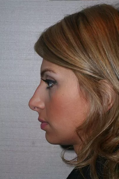 Female patient before primary rhinoplasty