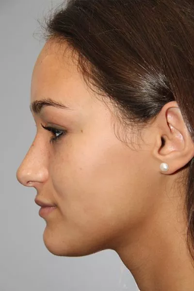 Female patient after primary rhinoplasty