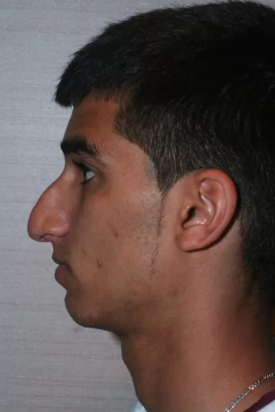 Male patient before primary rhinoplasty