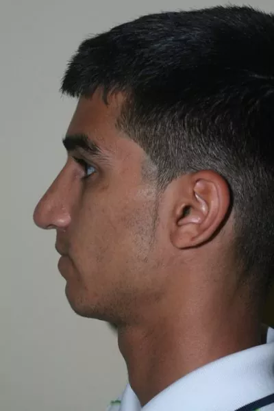Male patient after primary rhinoplasty