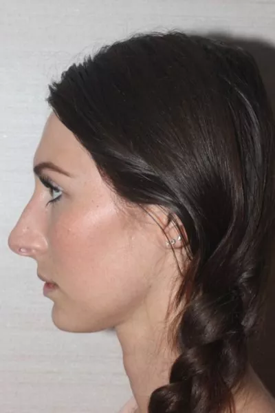 Female patient before primary rhinoplasty