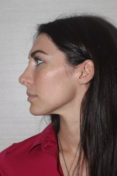 Female patient after primary rhinoplasty