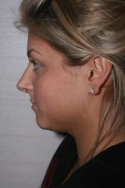 Female patient after primary rhinoplasty