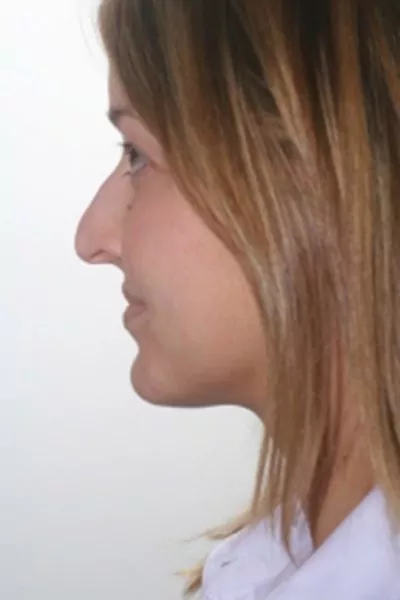 Female patient before primary rhinoplasty