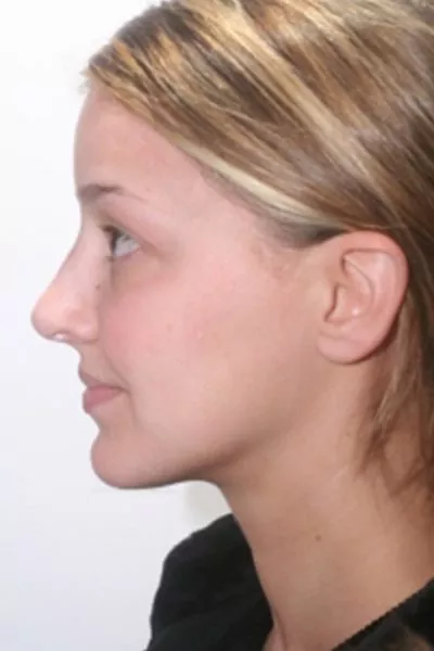 Female patient after primary rhinoplasty